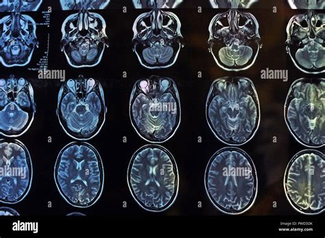 the villages brain mri|Neurosciences .
